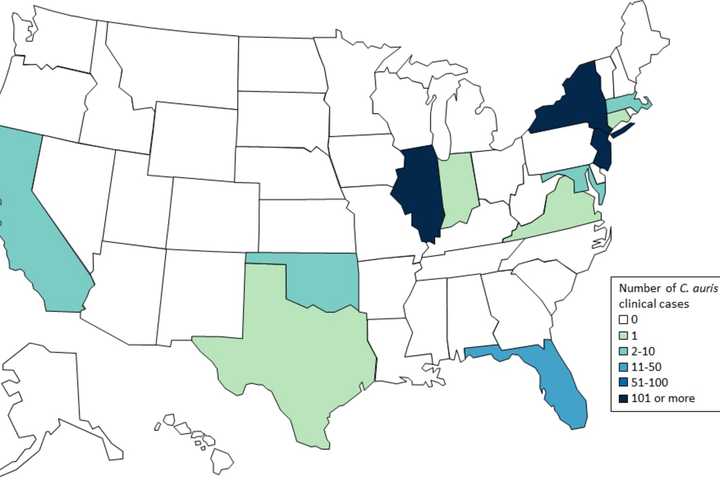 What You Need To Know: Outbreak Of Dangerous, Drug-Resistant Fungus Reported In New Jersey