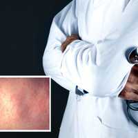 Measles Exposure Alert: Out-of-State Visitor With Virus Stops In 4 Counties: PA Dept. Of Health