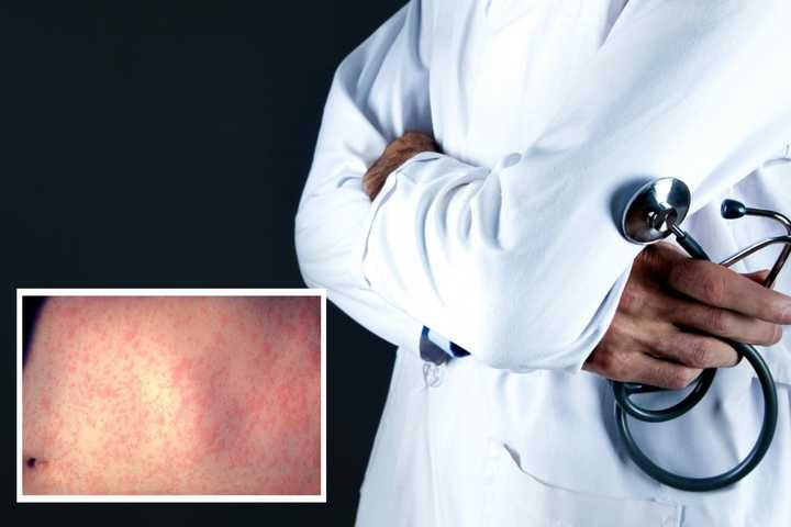 Possible Measles Exposures Reported At Elizabeth Longshoreman's Strike