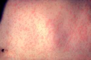 Measles Reported In Englewood, Newark Airport: Health Department Warns