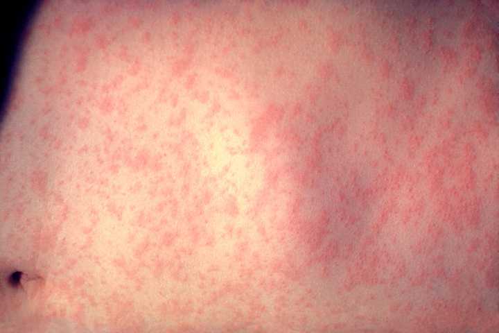 Measles Reported In Englewood, Newark Airport: Health Department Warns