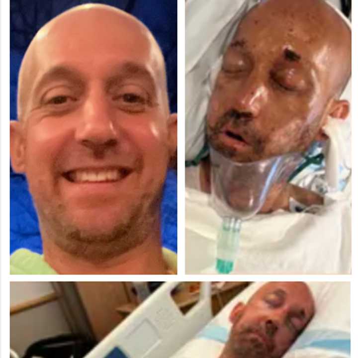 Brian Ginter before (top left) and after the Independence Day fireworks exploded in his face, according to a GoFundMe launched to help his family.&nbsp;