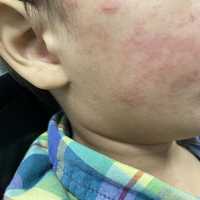 Measles Surge: Nearly 1,000 Cases Reported In US As Outbreaks Explode