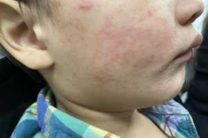 Measles Surge: Nearly 1,000 Cases Reported In US As Outbreaks Explode