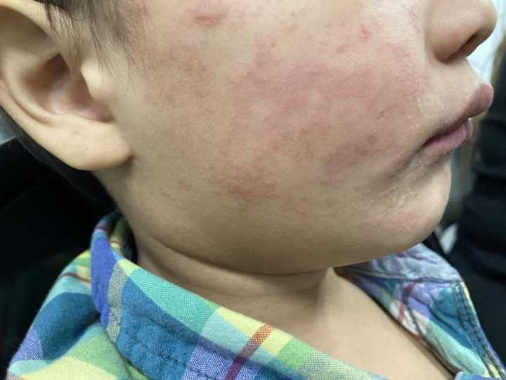 Measles