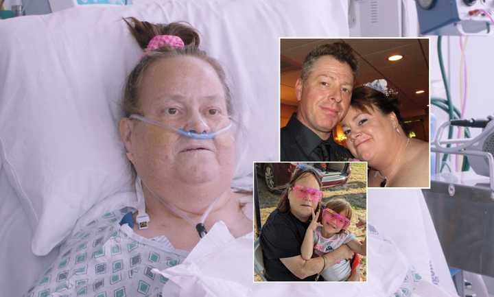 Lisa Pisano, the second-ever recipient of a heart pump and pig kidney combo, has died.