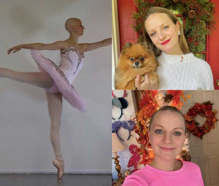 Maggie Kudirka, the "Bald Ballerina" has died after an inspirational cancer battle.