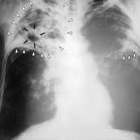 Tuberculosis Scare At Suffolk HS Prompts Testing Of 100+; District's Response Criticized