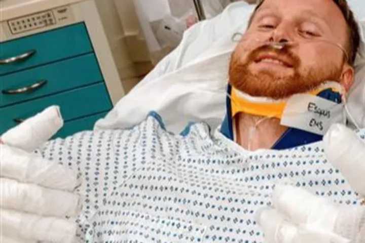 Support Swells For Port Ewen Man Severely Burned In Fire, Family Who’s 'Starting Over'