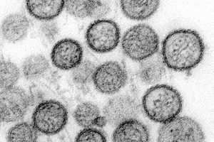 American Dies From Hantavirus In Case Not Linked To Cruise Ship Outbreak