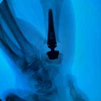 Jersey Shore University Medical Center First In NJ To Offer Advanced Thumb Joint Replacement