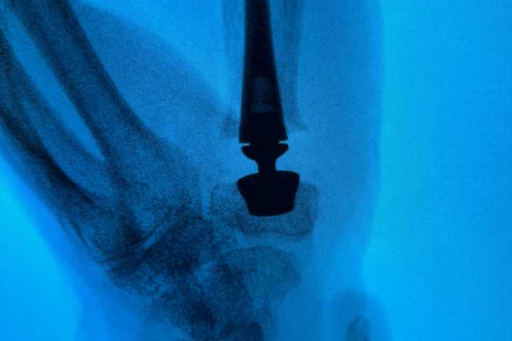 Jersey Shore University Medical Center First In NJ To Offer Advanced Thumb Joint Replacement